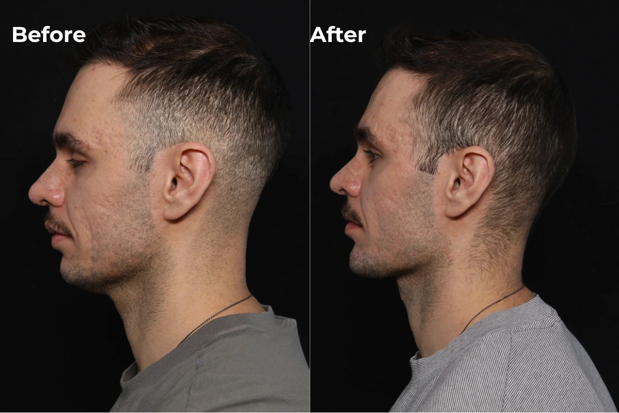 Custom chin and jaw implant before and after, side profile view, Newport Beach patient