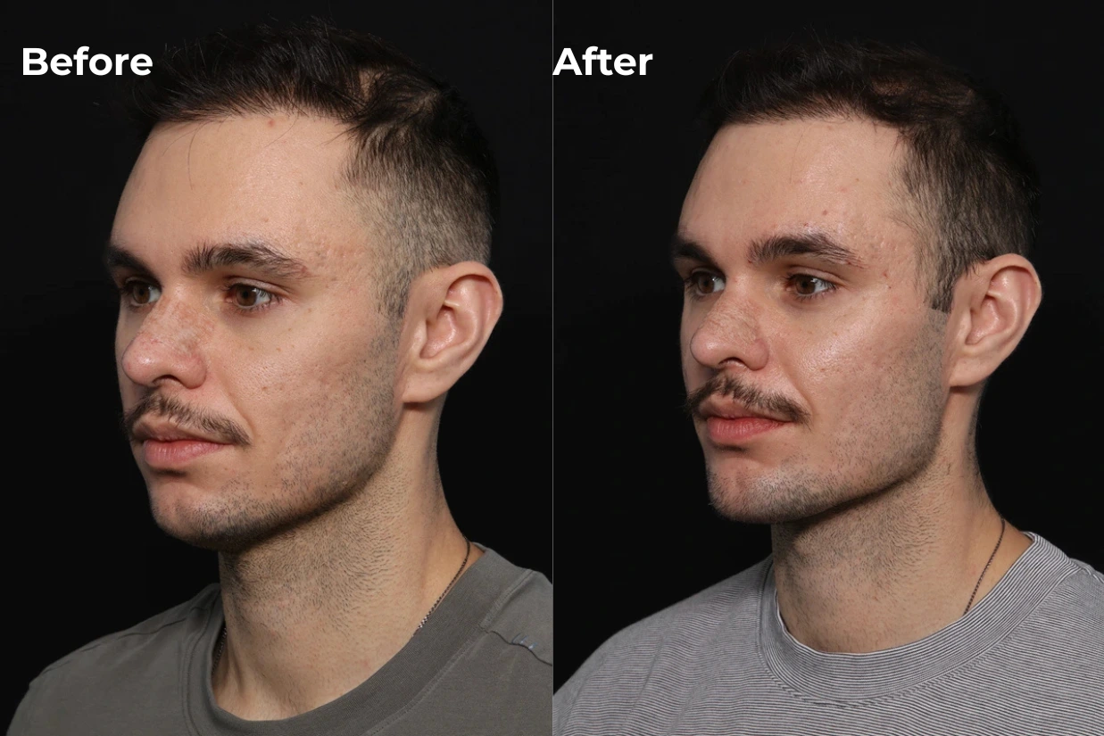 Custom chin and jaw implant before and after, oblique view