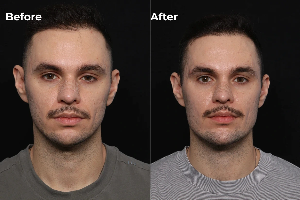 Custom chin and jaw implant before and after, front view
