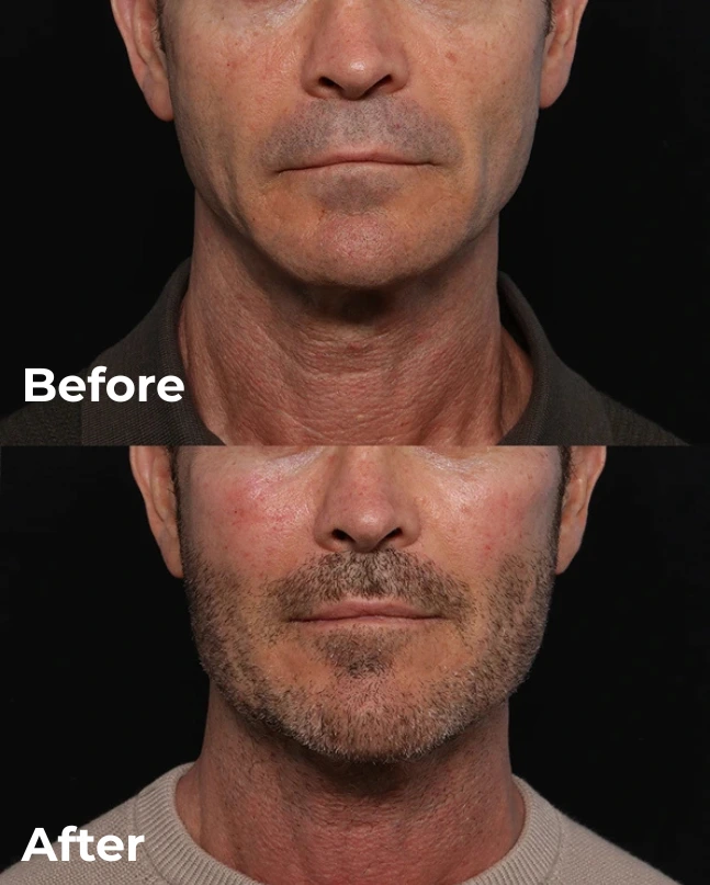 Custom jaw angle implant before and after, side profile view, Newport Beach patient