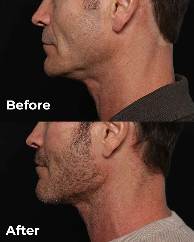 Custom jaw angle implant before and after, oblique view