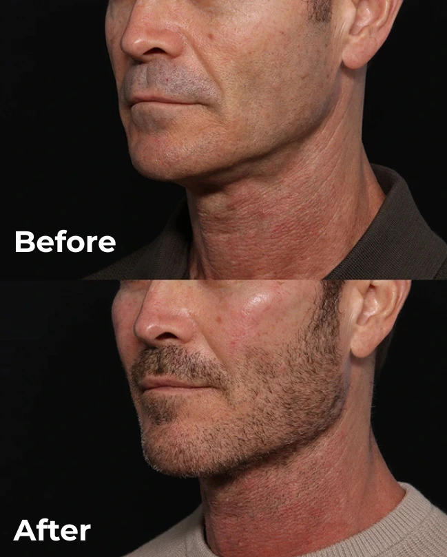 Custom jaw angle implant before and after, front view